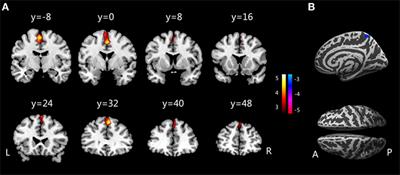 Morphometric Magnetic Resonance Imaging Study in Children With Primary Monosymptomatic Nocturnal Enuresis